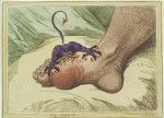 Lịch sử bệnh gout 