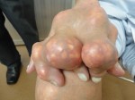 Giải pháp điều trị toàn diện cho bệnh nhân gout 